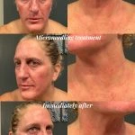 Timeless Youth MD Before After Microneedling PRP Treatments Treatment B In West Des Moines, IA